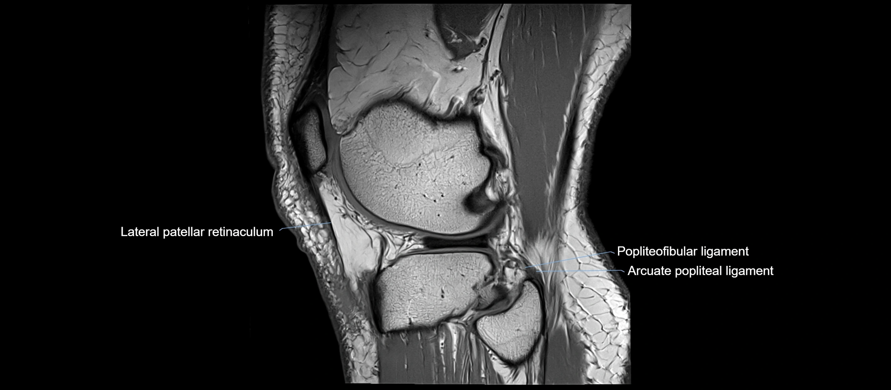 MRI sagittal  ligaments cross sectional anatomy 3T  radiology  image-img-00001-00039.webp